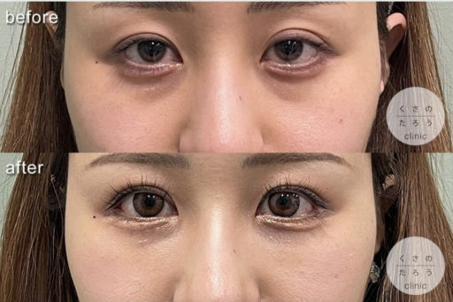 眼瞼下垂 目尻切開 脱脂＋脂肪注入