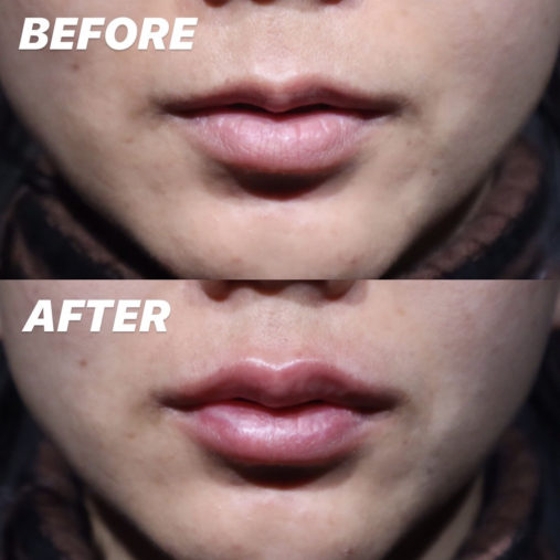 唇ヒアルロン酸