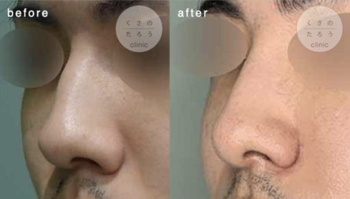ハンプ削り 耳介軟骨移植 鼻翼縮小