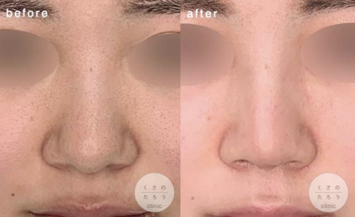 鼻中隔延長 シリコンプロテーゼ