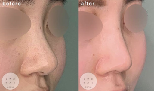 鼻中隔延長 シリコンプロテーゼ
