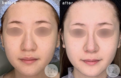 鼻中隔延長 鼻翼縮小 シリコンプロテーゼ