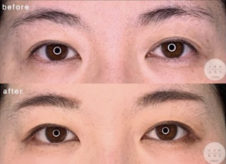 目尻切開