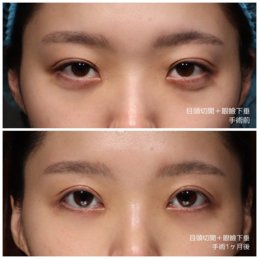 目頭切開 眼瞼下垂