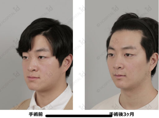 両顎手術 Vライン形成