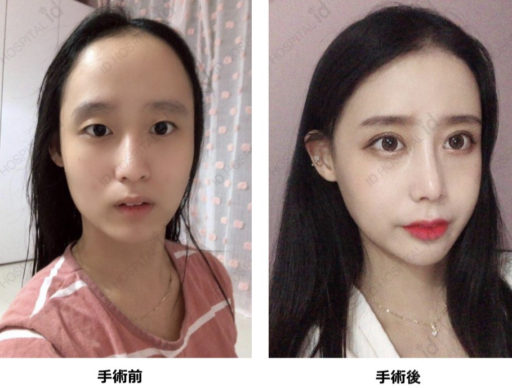 眼瞼下垂(再手術)、鼻整形、Vライン形成、頬骨最大縮小、ヘアライン、脂肪移植