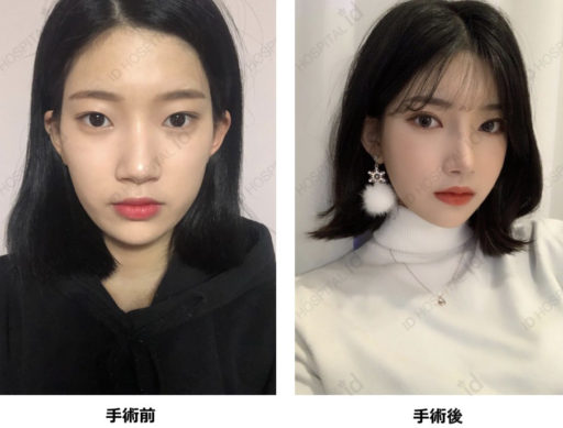 眼瞼下垂、たれ目形成、目尻切開、鼻整形、Vライン形成、頬骨最大縮小、アキュレーザー、脂肪移植