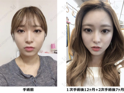 眼下脂肪再配置 Vライン形成 V3フェイスリフト 脂肪移植