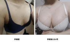 ハイブリッド豊胸