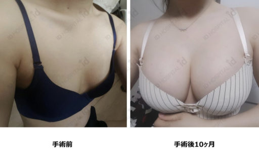 ハイブリッド豊胸