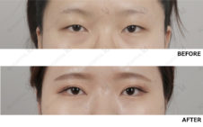 眼瞼下垂 たれ目形成 目尻切開