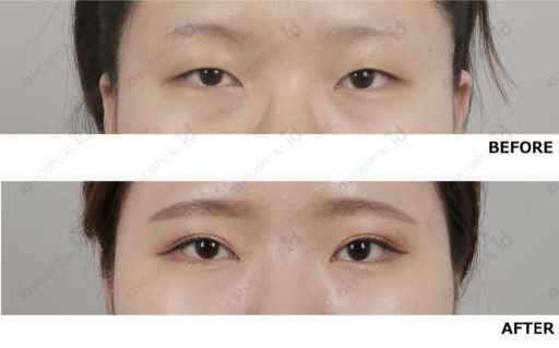 眼瞼下垂 たれ目形成 目尻切開