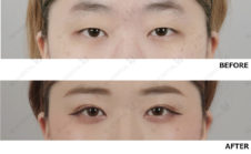 眼瞼下垂