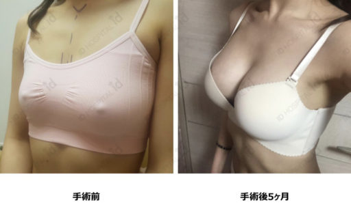 ハイブリッド豊胸