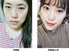 眼瞼下垂 たれ目形成 目尻切開
