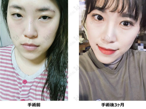 眼瞼下垂 たれ目形成 目尻切開