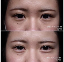 涙袋ヒアルロン酸