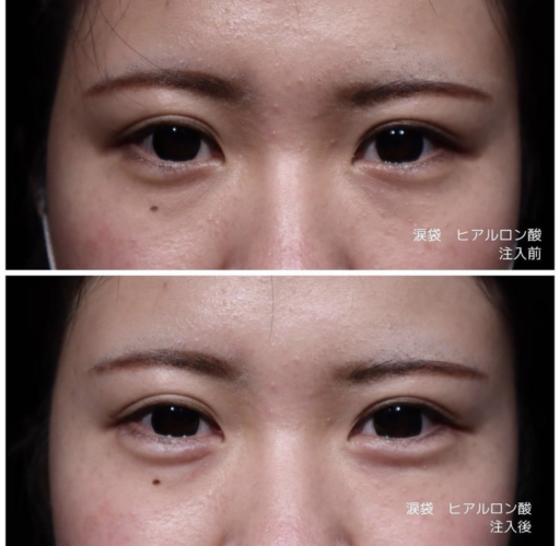 涙袋ヒアルロン酸