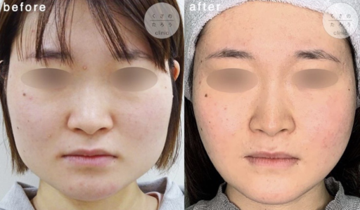 頬骨骨切り 下顎角部骨切り 咬筋切除