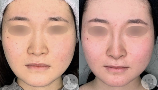 鼻中隔延長 シリコンプロテーゼ