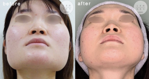 頬骨骨切り 下顎角部骨切り 咬筋切除