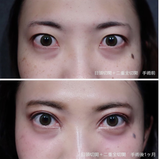 目頭切開 二重全切開