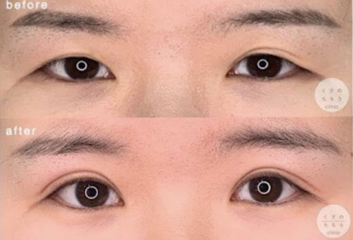 二重全切開 (他院修正)