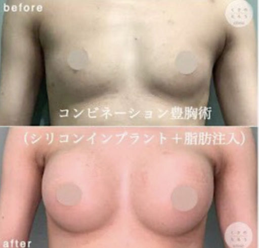 シリコンバッグ＋脂肪注入豊胸