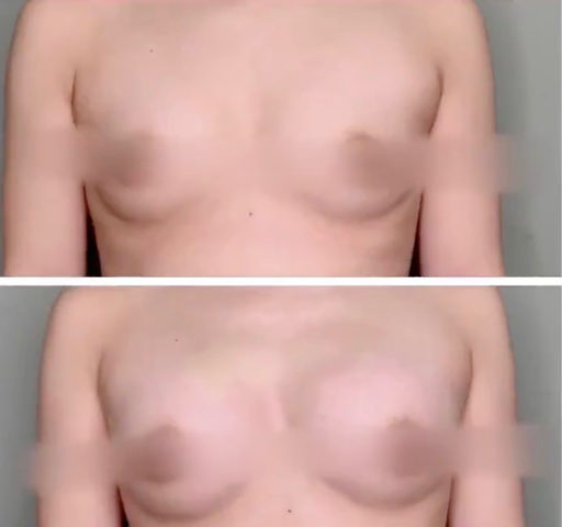 ヒアルロン酸豊胸