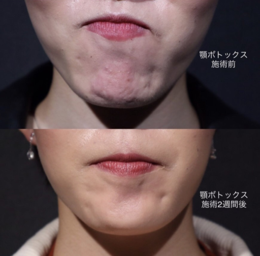 顎ボトックス