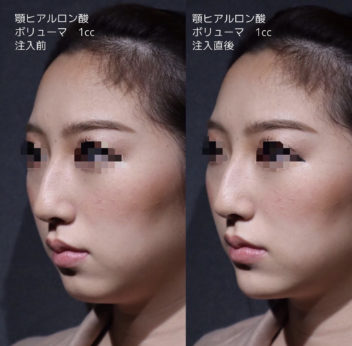 顎ヒアルロン酸