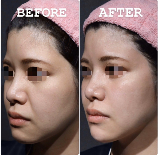 ヒアルロン酸リフト