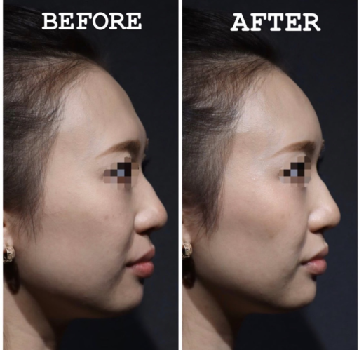 額ヒアルロン酸