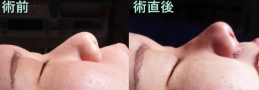 鼻尖形成 小鼻縮小