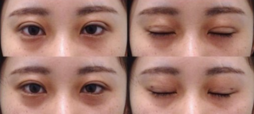 眼瞼下垂