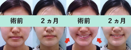 バッカルファット