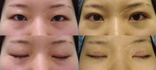 二重埋没 上瞼脱脂 下眼瞼脱脂