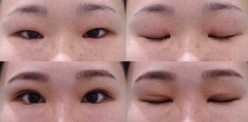 二重埋没 上瞼脱脂 目頭切開