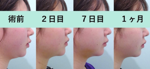 頬・顎下脂肪吸引
