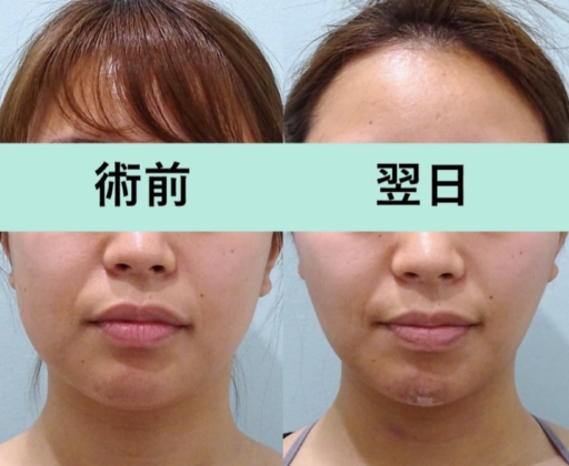 頬・顎下脂肪吸引 バッカルファット