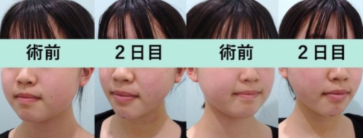 頬・顎下脂肪吸引