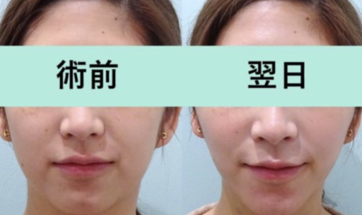 頬・顎下脂肪吸引 スレッドリフト 顎ボトックス