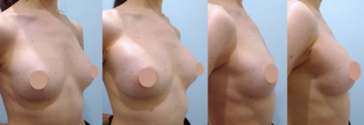 ヒアルロン酸豊胸