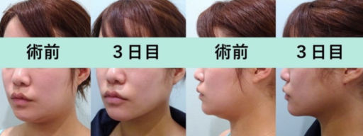 頬・顎下脂肪吸引 エラボトックス