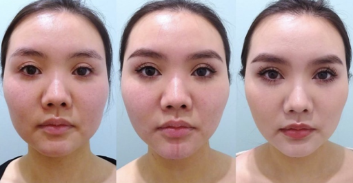 頬・顎下脂肪吸引 バッカルファット スレッドリフト 顎ボトックス