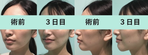 頬・顎下脂肪吸引