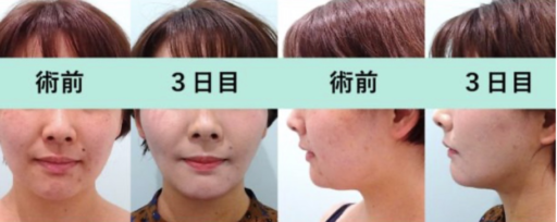 頬・顎下脂肪吸引 スレッドリフト