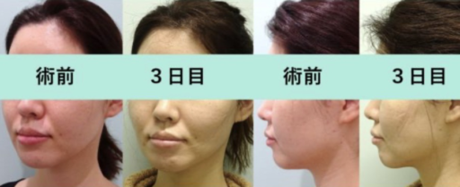 頬・顎下脂肪吸引