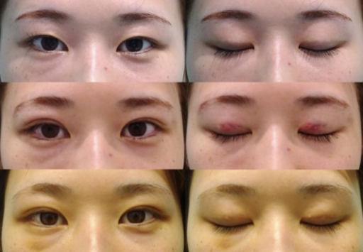 二重埋没 上瞼脱脂