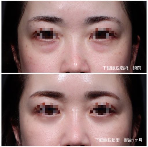 下眼瞼脱脂